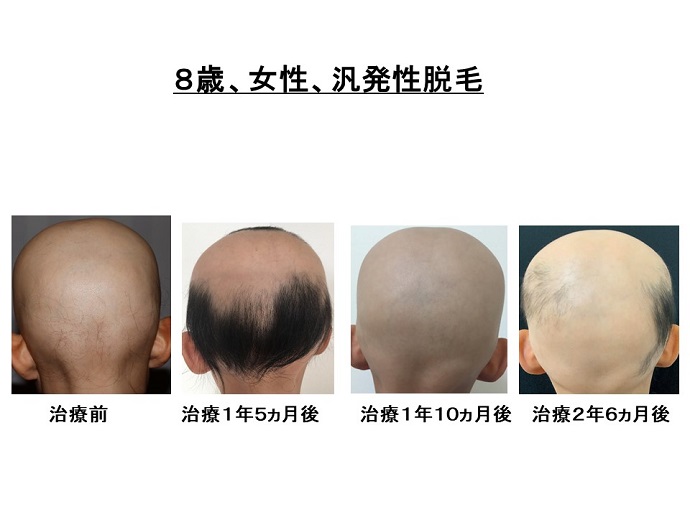 円形脱毛症　病院